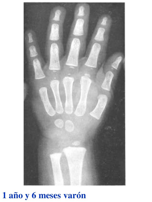 Atlas greulich y pyle