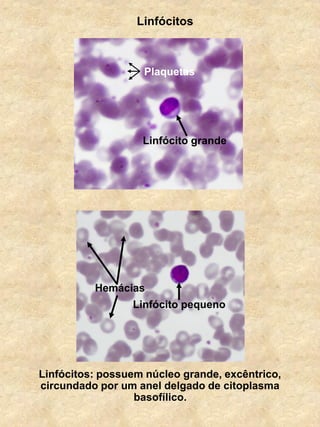 Linfócitos: possuem núcleo grande, excêntrico,
circundado por um anel delgado de citoplasma
basofílico.
Linfócito grande
Linfócito pequeno
Hemácias
Linfócitos
Plaquetas
 