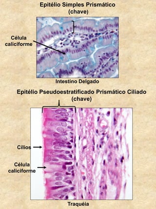 Epitélio Simples Prismático
(chave)
Intestino Delgado
Epitélio Pseudoestratificado Prismático Ciliado
(chave)
Célula
caliciforme
Cílios
Traquéia
Célula
caliciforme
 