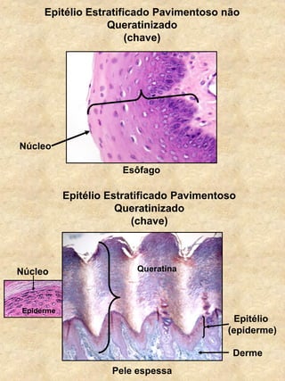 Epitélio Estratificado Pavimentoso não
Queratinizado
(chave)
Esôfago
Núcleo
Epitélio Estratificado Pavimentoso
Queratinizado
(chave)
Queratina
Epitélio
(epiderme)
Pele espessa
Derme
Núcleo
Epiderme
 