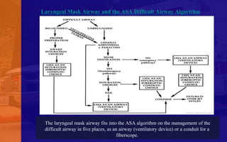 Laryngeal Mask Airway & Igel - An Introduction | PDF