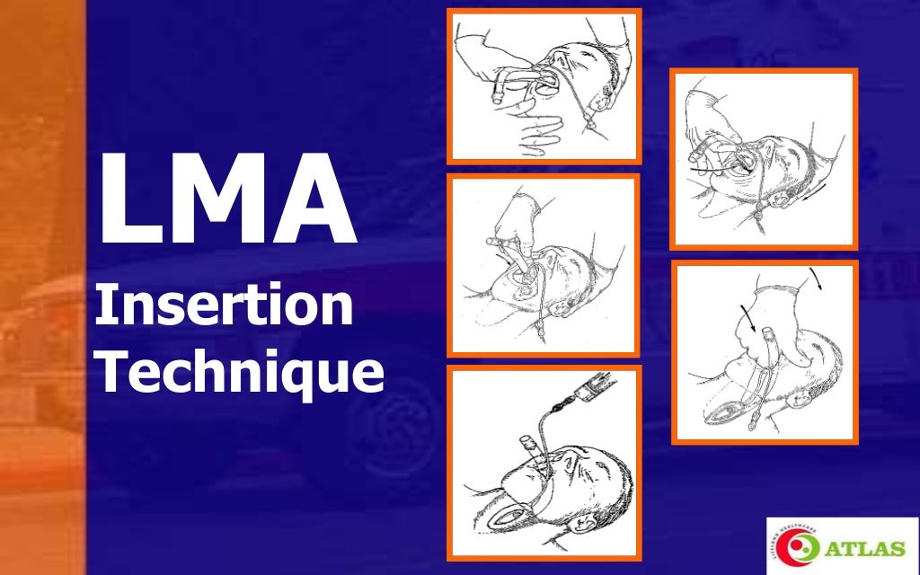 Laryngeal Mask Airway & Igel An Introduction