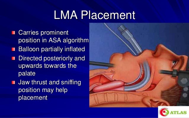 laryngeal mask airway igel an introduction