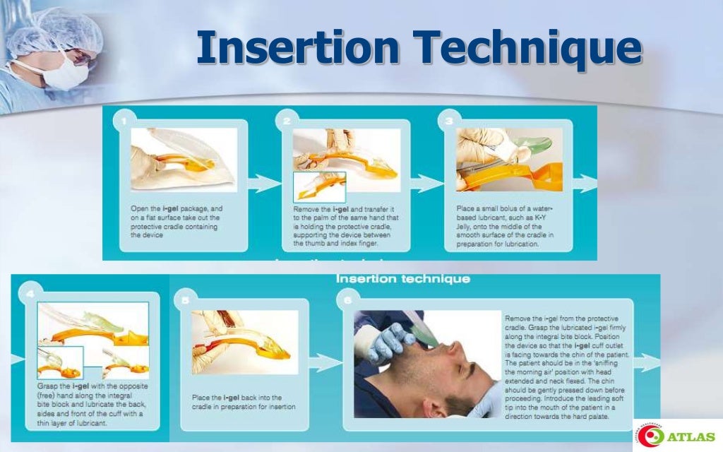 Laryngeal Mask Airway & Igel An Introduction
