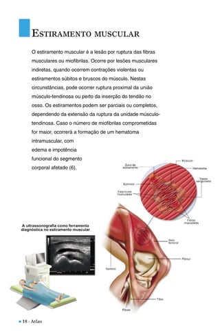 n 18 - Atlas
O estiramento muscular é a lesão por ruptura das fibras
musculares ou miofibrilas. Ocorre por lesões musculares
indiretas, quando ocorrem contrações violentas ou
estiramentos súbitos e bruscos do músculo. Nestas
circunstâncias, pode ocorrer ruptura proximal da união
músculo-tendinosa ou perto da inserção do tendão no
osso. Os estiramentos podem ser parciais ou completos,
dependendo da extensão da ruptura da unidade músculo-
tendinosa. Caso o número de miofibrilas comprometidas
for maior, ocorrerá a formação de um hematoma
intramuscular, com
edema e impotência
funcional do segmento
corporal afetado (6).
ESTIRAMENTO MUSCULAR
 