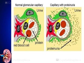 Nephrocity Nephrotic Syndrome | PPTX