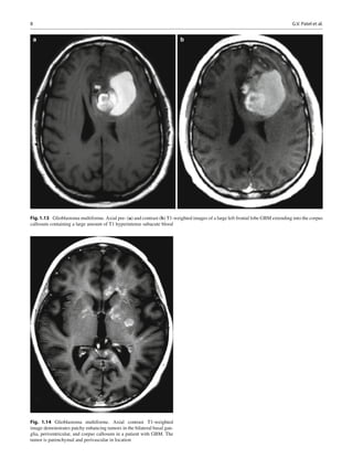 Atlas of brain and spine oncology imaging | PDF