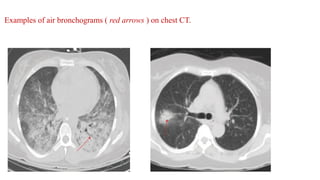 Atlas of chest imaging | PDF