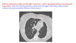 Spiculation Sign Atlas of chest imaging | PDF