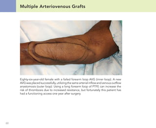 Atlas of dialysis vascular access | PDF