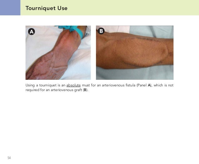 Atlas of dialysis vascular access