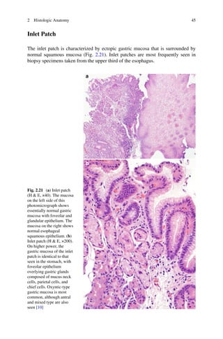 Atlas of esophageal disease and intervention | PDF