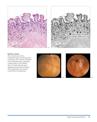 Normal Antrum Visual Atlas of gastrointestinal endoscopy and related pathology (blackwell ...