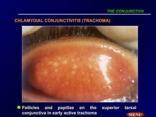 Trachom Atlas of opthalmology_tanta_university | PPT