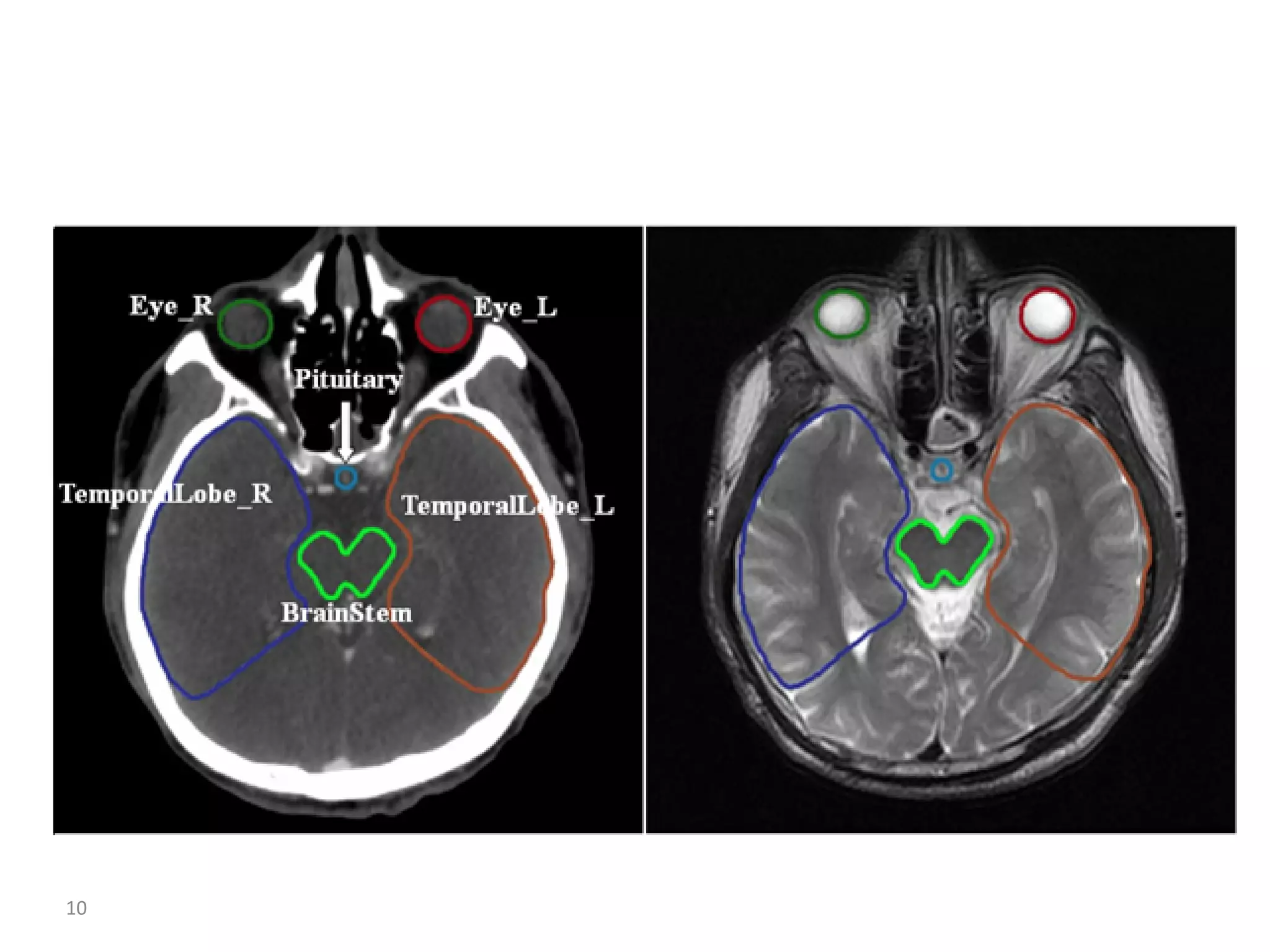 Atlas of organs at risk delineation head and neck region | PDF