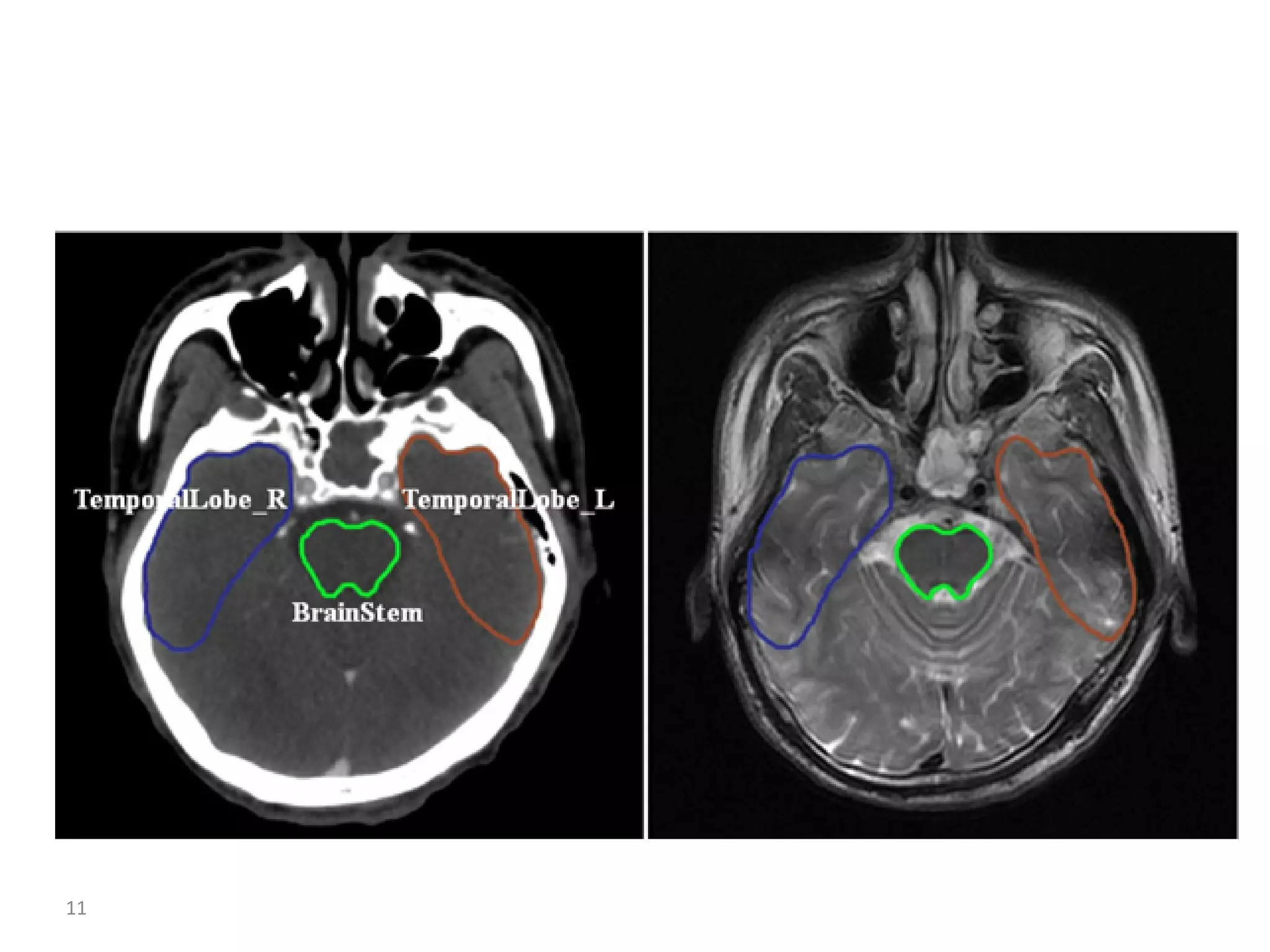 Atlas of organs at risk delineation head and neck region | PDF