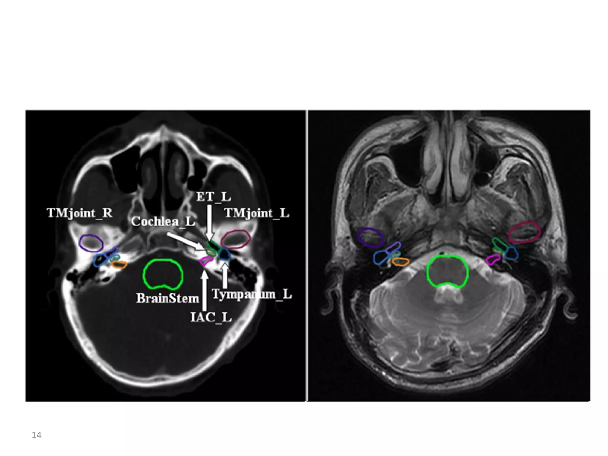 Atlas of organs at risk delineation head and neck region | PDF
