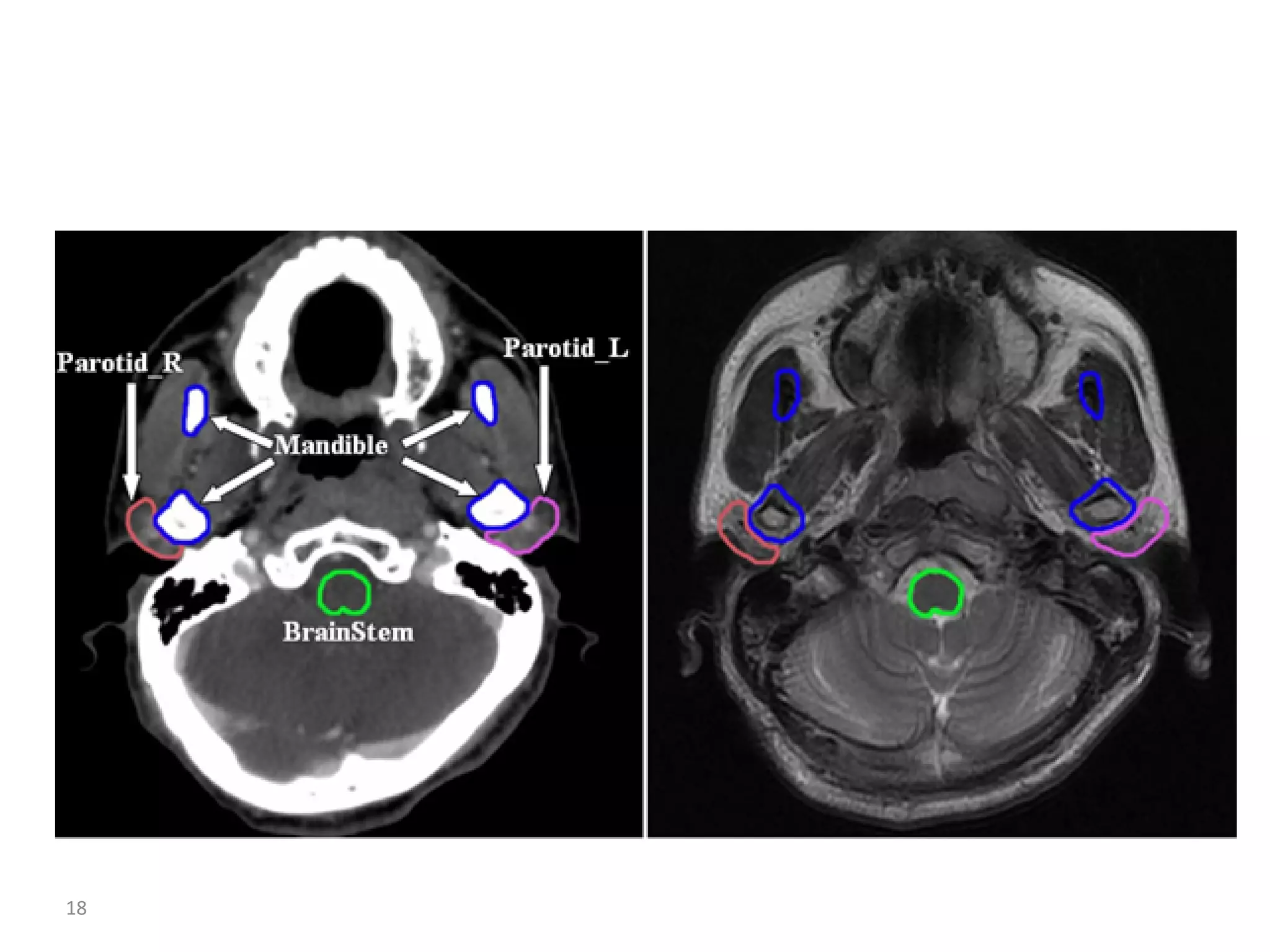 Atlas of organs at risk delineation head and neck region | PDF