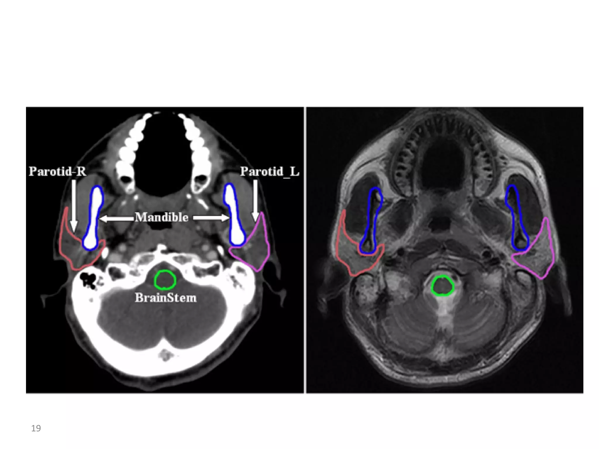 Atlas of organs at risk delineation head and neck region | PDF