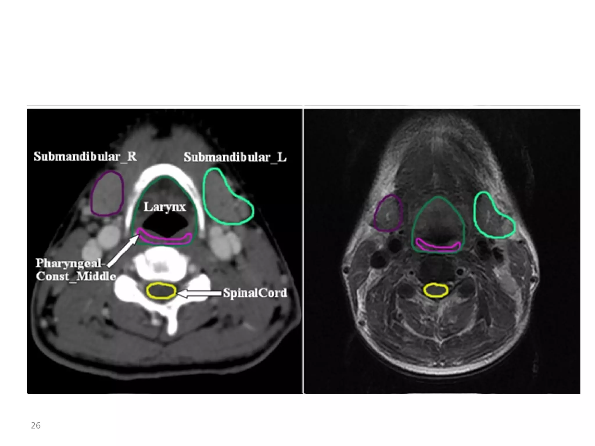Atlas of organs at risk delineation head and neck region | PDF
