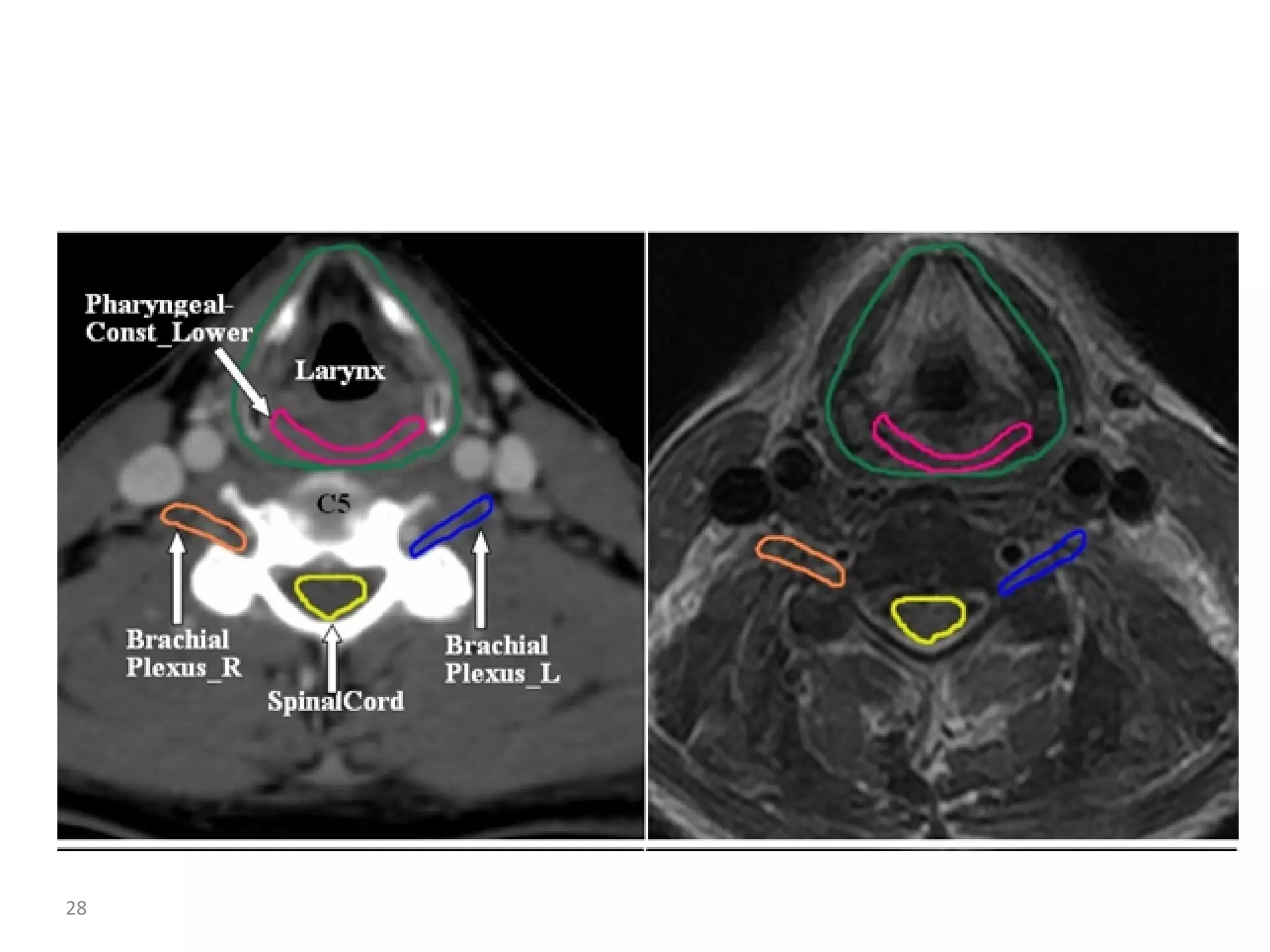 Atlas of organs at risk delineation head and neck region | PDF