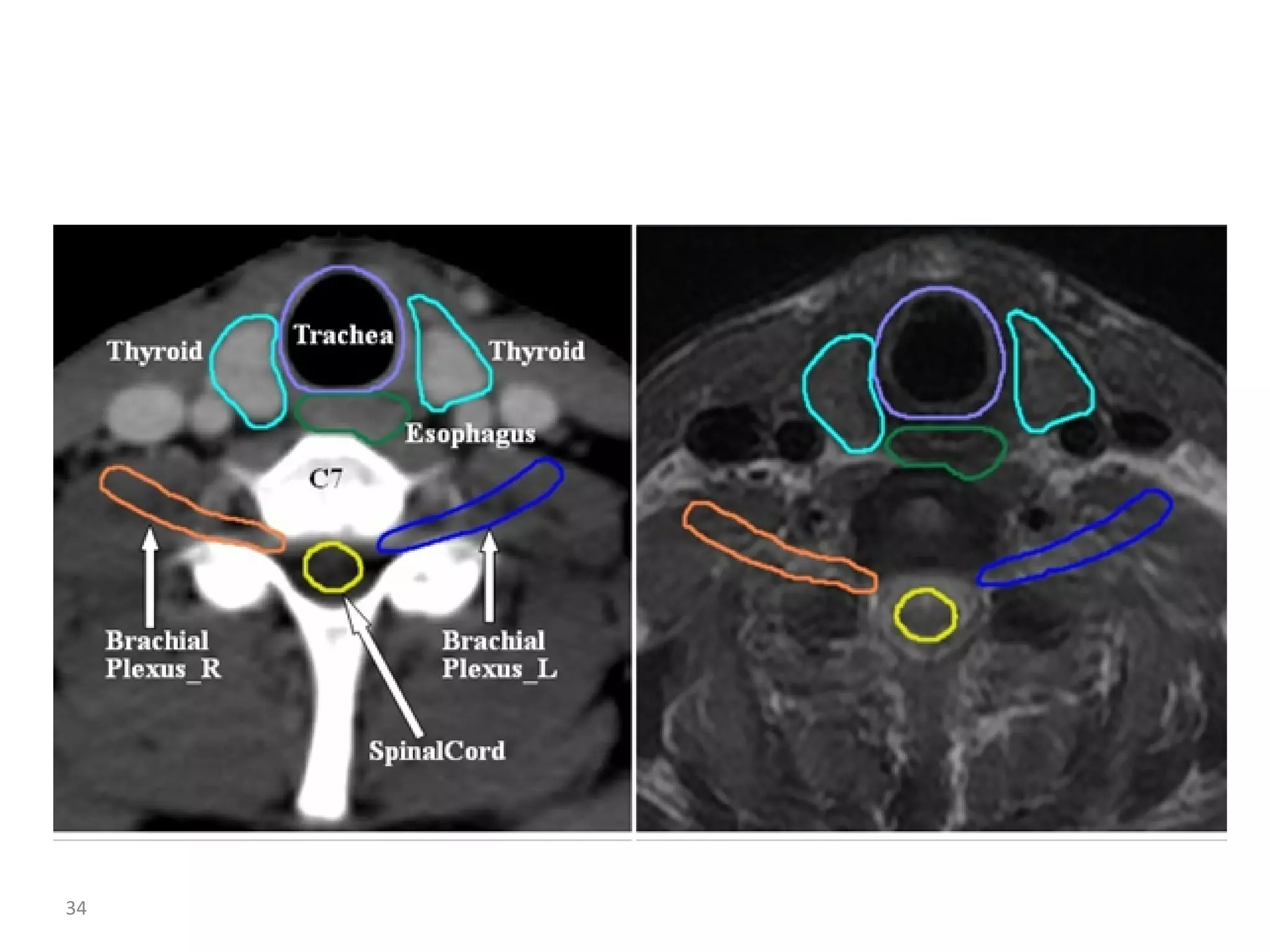 Atlas of organs at risk delineation head and neck region | PDF