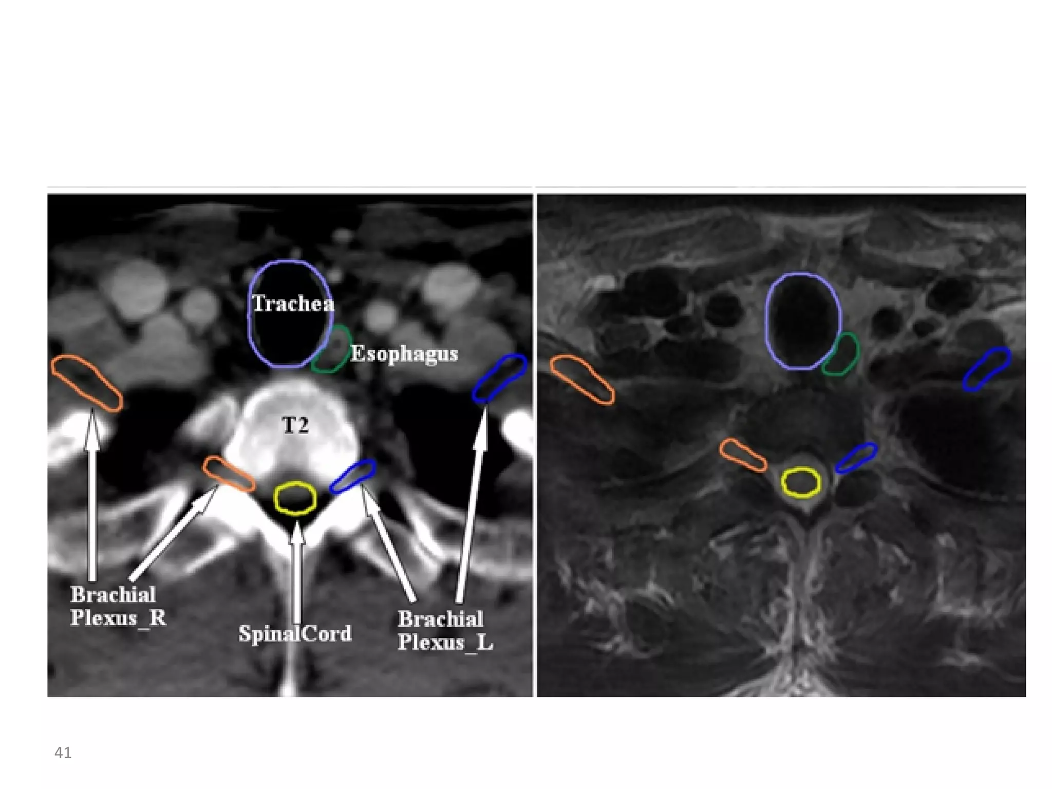 Atlas of organs at risk delineation head and neck region | PDF
