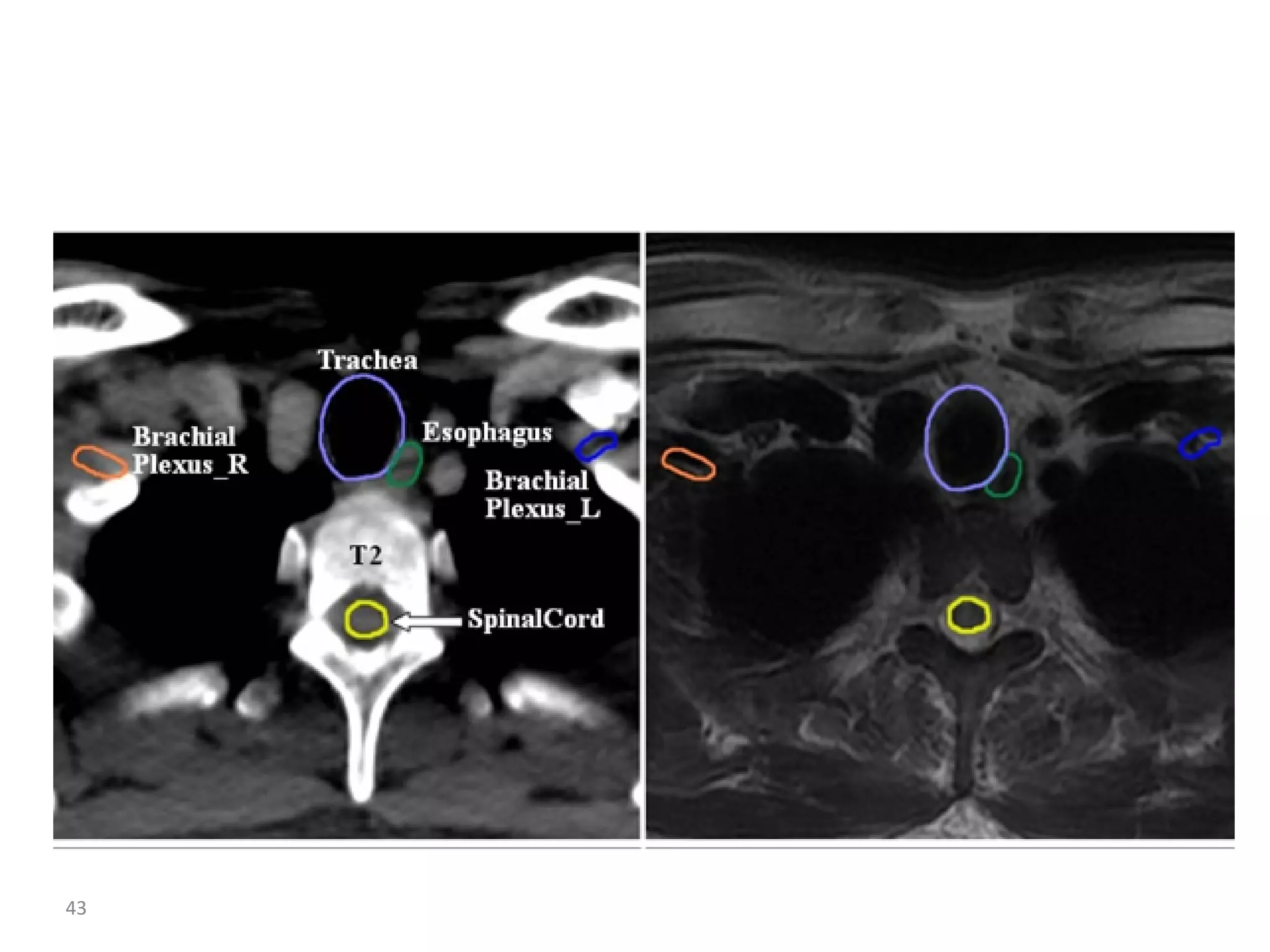 Atlas of organs at risk delineation head and neck region | PDF