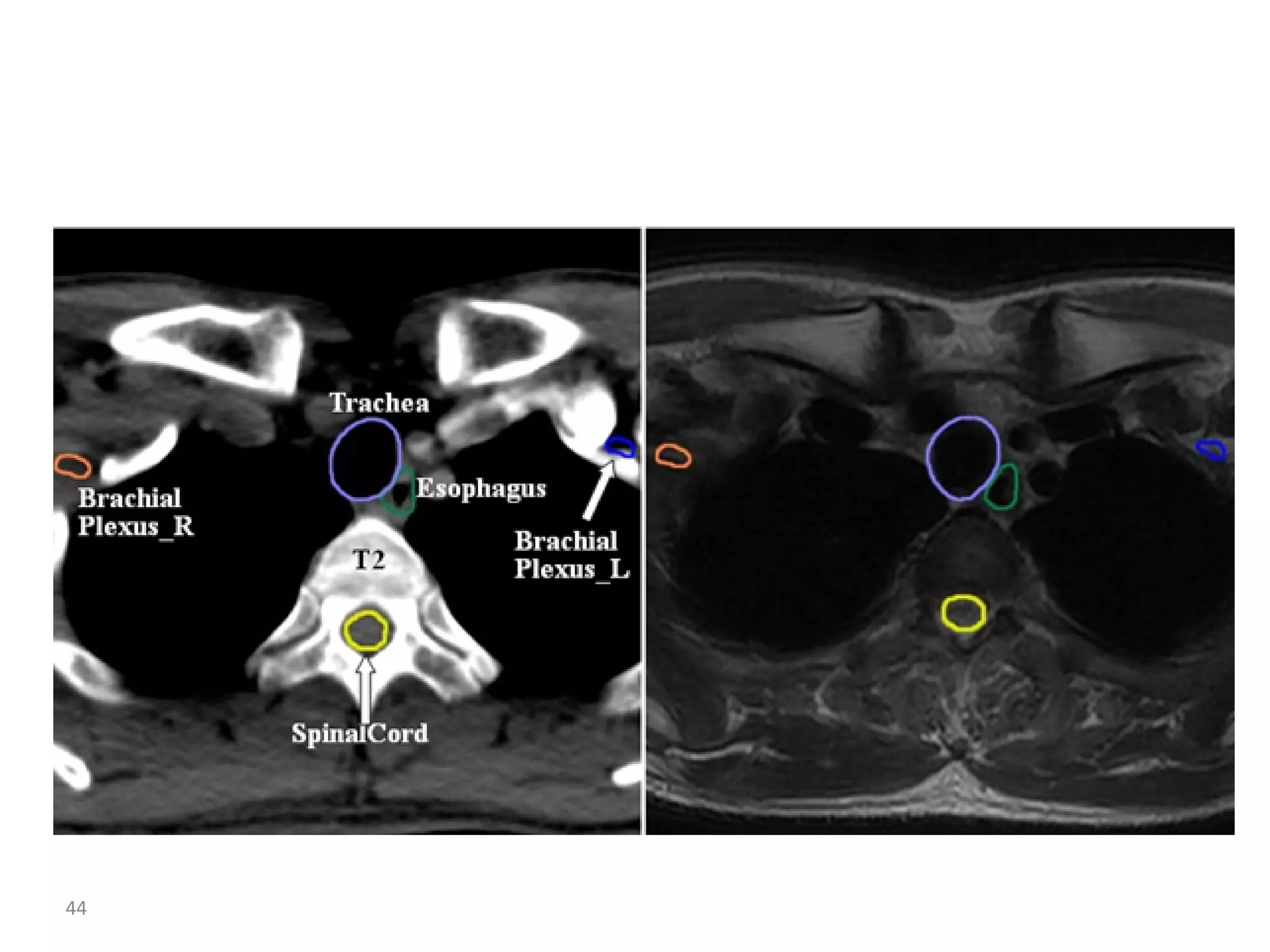 Atlas of organs at risk delineation head and neck region | PDF