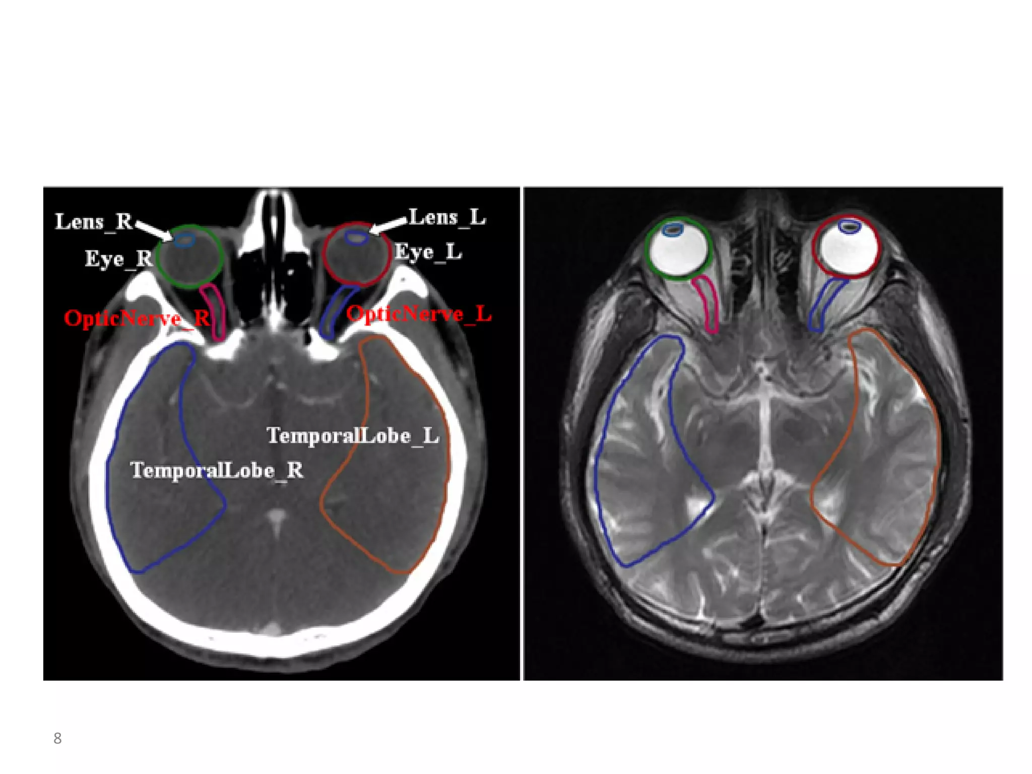 Atlas of organs at risk delineation head and neck region | PDF