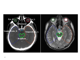 Atlas of organs at risk delineation head and neck region | PDF