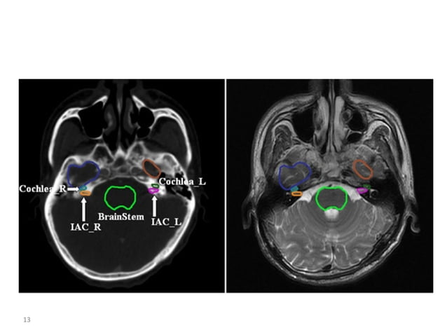 Atlas of organs at risk delineation head and neck region | PDF