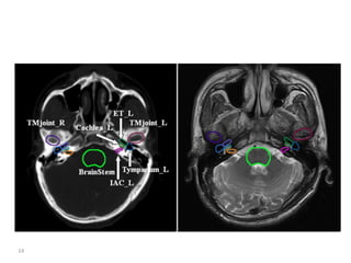 Atlas of organs at risk delineation head and neck region | PDF