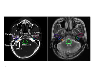 Atlas of organs at risk delineation head and neck region | PDF