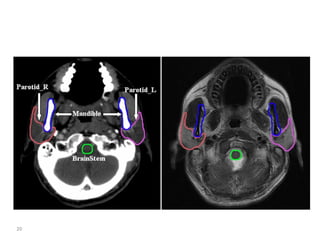 Atlas of organs at risk delineation head and neck region | PDF