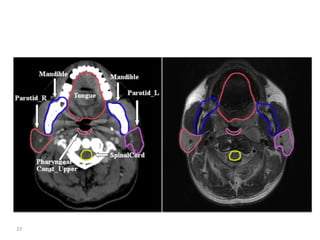 Atlas of organs at risk delineation head and neck region | PDF