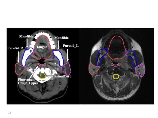 Atlas of organs at risk delineation head and neck region | PDF
