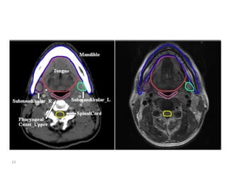 Atlas of organs at risk delineation head and neck region | PDF