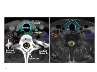 Atlas of organs at risk delineation head and neck region | PDF