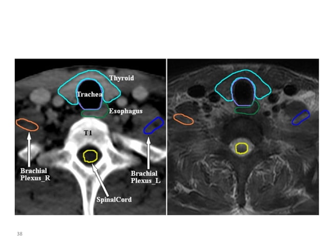Atlas of organs at risk delineation head and neck region | PDF