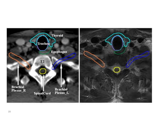 Atlas of organs at risk delineation head and neck region | PDF