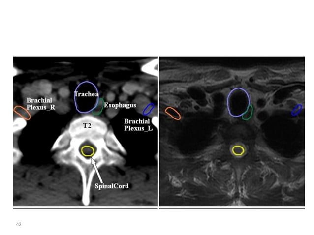 Atlas of organs at risk delineation head and neck region | PDF