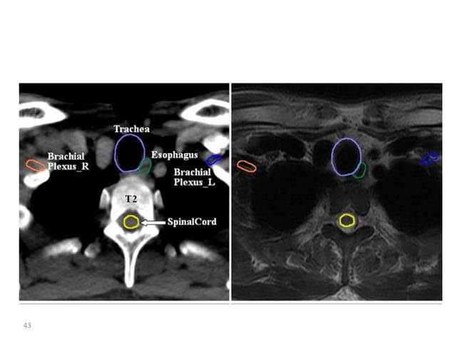 Atlas of organs at risk delineation head and neck region | PDF