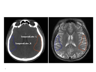Atlas of organs at risk delineation head and neck region | PDF
