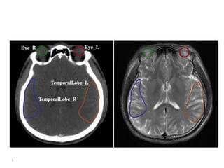 Atlas of organs at risk delineation head and neck region | PDF