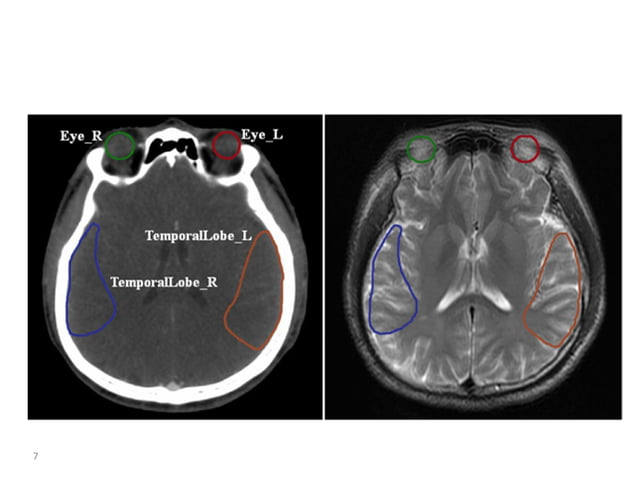 Atlas of organs at risk delineation head and neck region | PDF