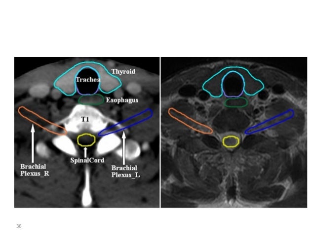 Atlas of organs at risk delineation head and neck region