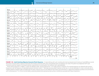 Normal And Benign Variants Atlas Of Pediatric Eeg