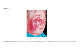 Atlas of Rashes Associated with Fever.pptx