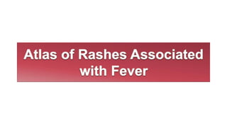 Atlas of Rashes Associated with Fever.pptx